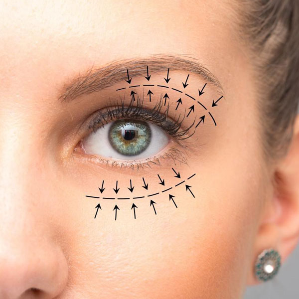 Blepharoplasty