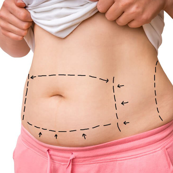 Abdominoplasty (Tummy Tuck)