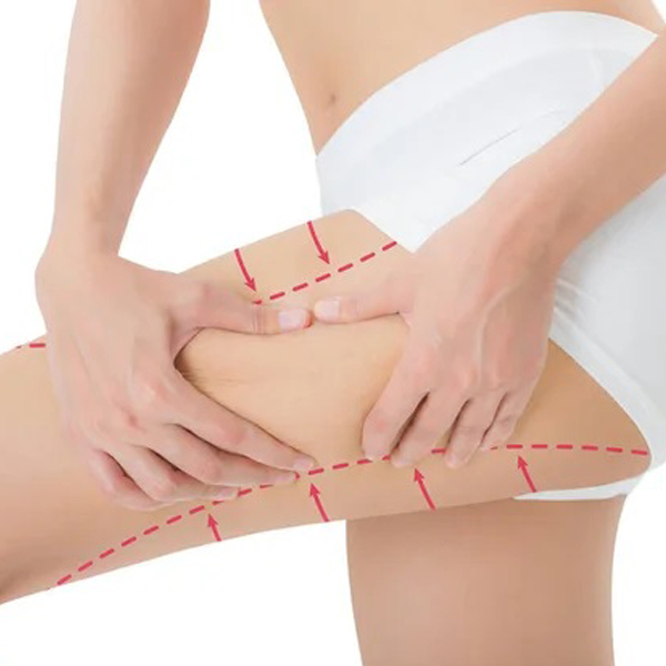 Thigh Lift