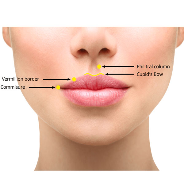 Upper Lip Lift