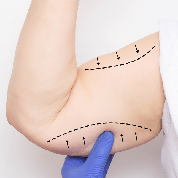 Brachioplasty (Arms Lift)
