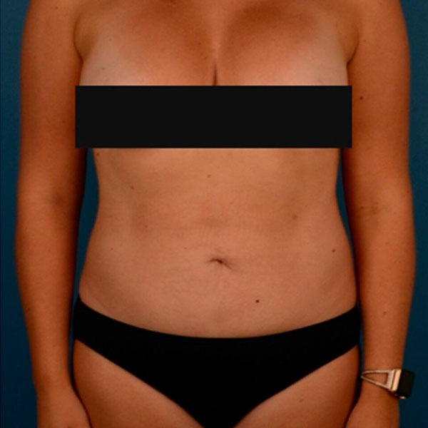 Trans-Abdominoplasty Breast Augmentation (TABA)