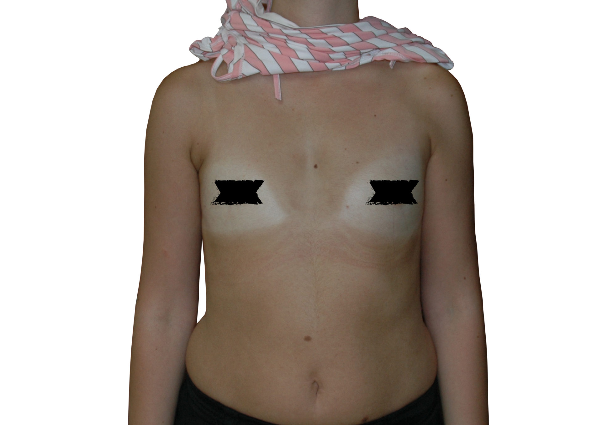 Before-Breast Augmentation